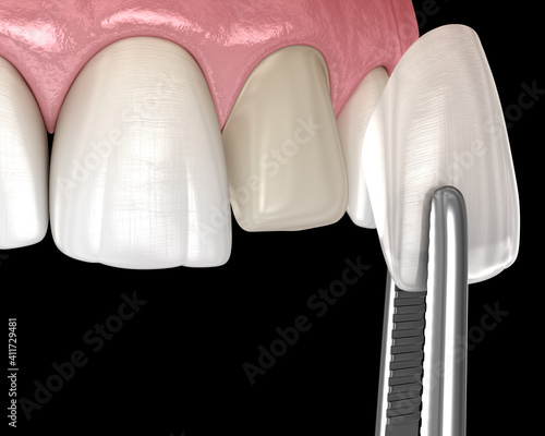 Veneer installation procedure over central incisor. Medically accurate tooth 3D illustration photo