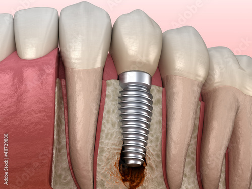 Periimplantitis with visible bone damage. Medically accurate 3D illustration of dental implants concept photo