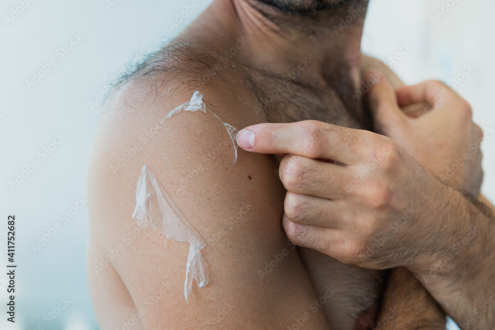 Fototapeta premium A man shaves the sunburned, dead skin from his shoulder.