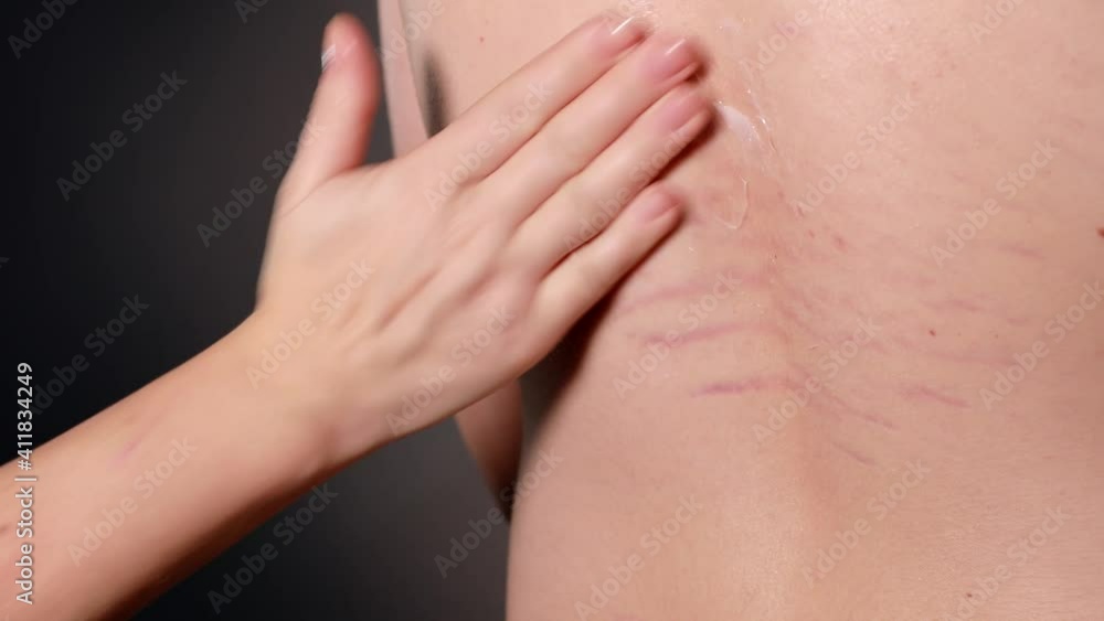 Close up view of the hand applying a drop of white cream on the young pearson's back with striae distensae (striae rubrae) background. The concept of impaired skin elasticity during puberty Close up view of the hand applying a drop of white cream on the young pearson's back with striae distensae (striae rubrae) background. The concept of impaired skin elasticity during puberty