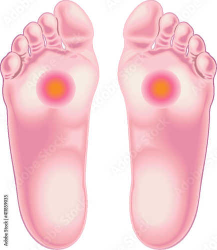 Illustration shows the feet area afflicted by the pain caused by metatarsalgia. photo
