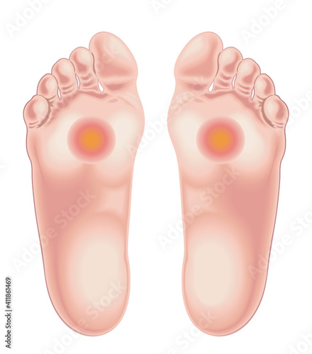 Illustration shows the feet area afflicted by the pain caused by metatarsalgia. photo