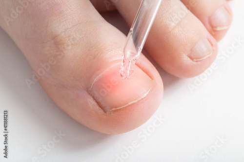 Applying medicated oil to the toenail to strengthen the nail plate and age the nail fungus, macro photo