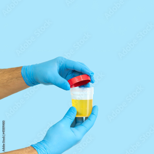 Nurse opening urine sample container for medical urinalysis