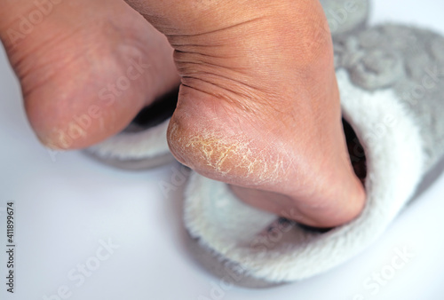 Fototapeta A woman foot  in winter slipper with dried skin problem