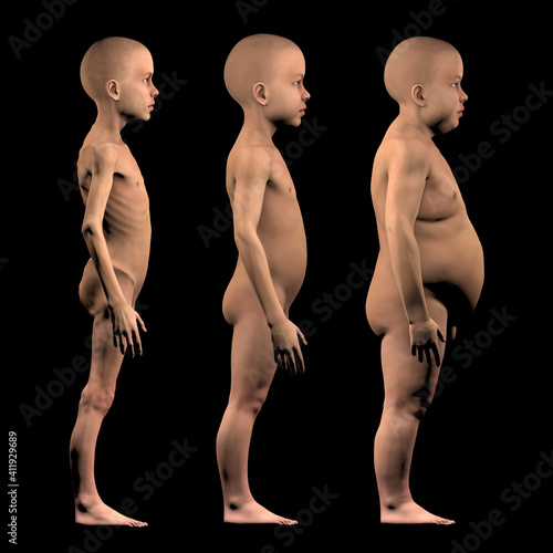 Quadro su tela Undernourished child, with normal build and obese child in comparison