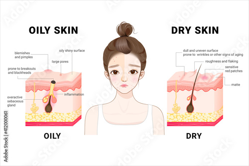 Oily & dry skin. Different. Human Skin types and conditions. A diagrammatic sectional view of the skin.  photo