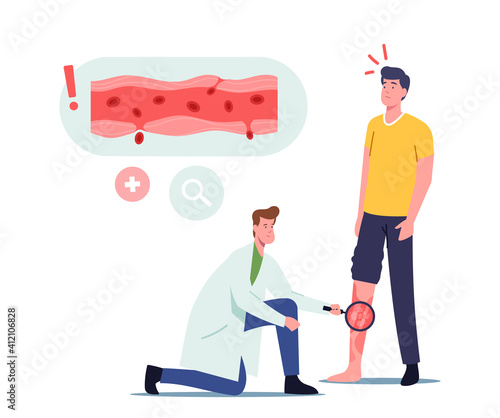 Vessels Inflammation, Rosacea Vasculitis Concept. Doctor Character with Magnifying Glass Looking on Patient Sick Foot