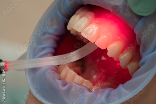 dental therapy with red LED lightred light therapy in a dental office photo