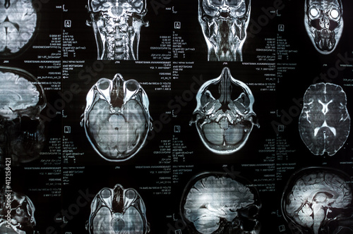 Magnetic resonance imaging of the brain close up. MRI photo