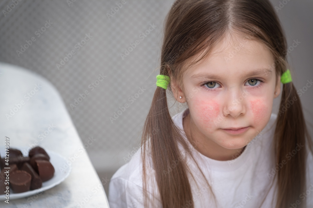 A little girl with an allergic rash on her cheeks sits at a table next