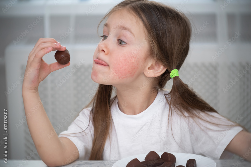 A little girl with an allergic rash on her cheeks sits at a table next
