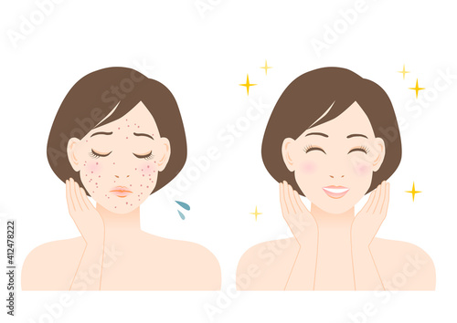 ニキビ・吹き出物に悩む女性のイラスト: ビフォーアフター