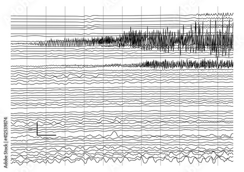 Vector Illustration of ictal EEG recording during seizure.