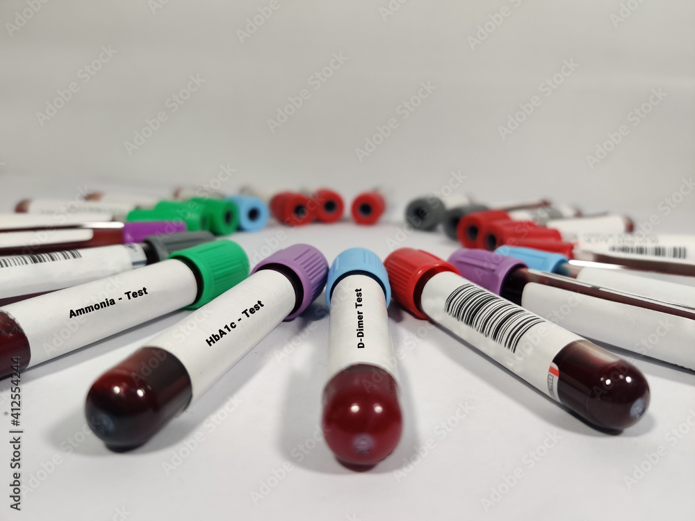 Blood sample for DDimer test, HbA1c Test and Ammonia test with various