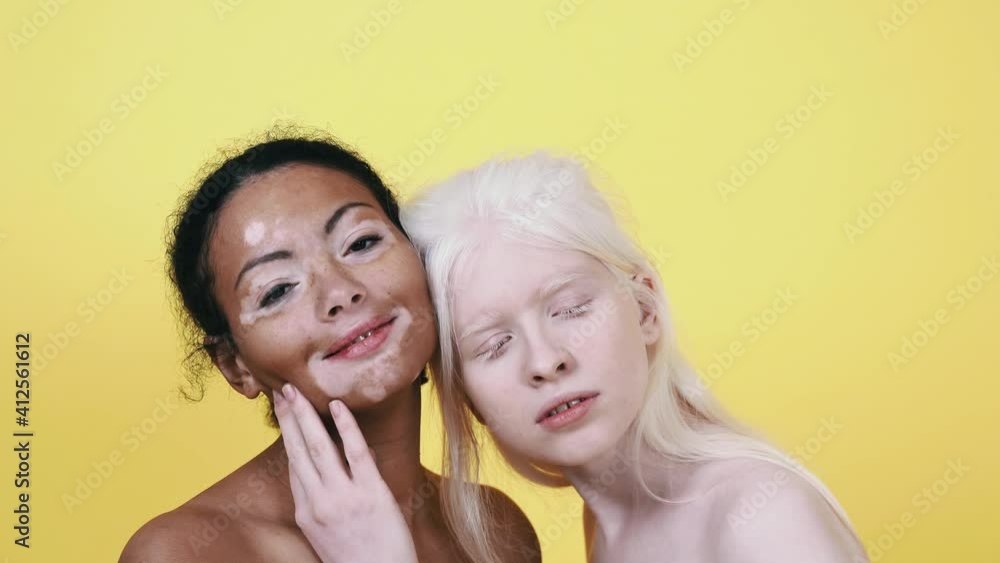 Diverse beauty concepts. Group of women with different kind of skin