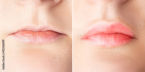 Lip augmentation before and after close up. Woman lips surgery, filler injection, mesotherapy, correction