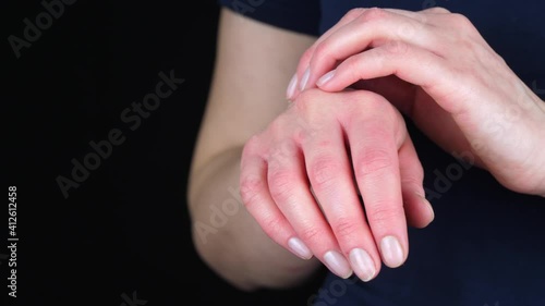 Wallpaper Mural Allergic reaction on the skin. Female hands close up on a black background. The girl touches the itchy, irritated skin. Health and environmental impact on the skin. Torontodigital.ca