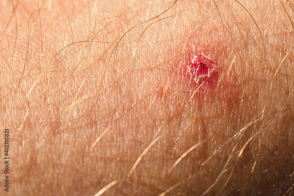 Torn Pimple On Human Skin In Macro Detail Stock Photo Adobe Stock