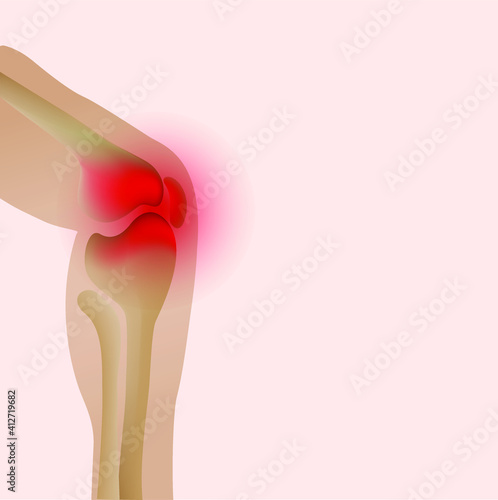 Joint pain illustration. Bone pain. Ache. Arthritis. Orthopedic medical concept.