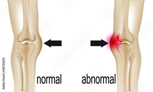 Joint pain illustration. Bone pain. Ache. Arthritis. Orthopedic medical concept.