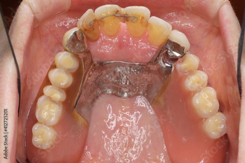 歯の喪失　入れ歯