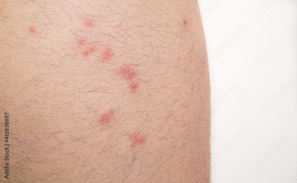 flea bites on caucasian man leg flea bites on caucasian man leg