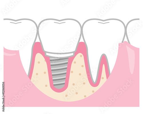 歯　インプラント