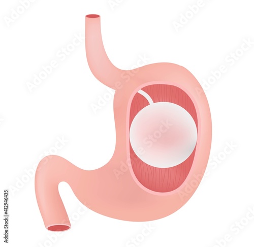 The gastric balloon.