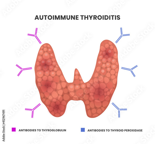 Illustration of the autoimmune thyroiditis. Vector illustration of the antibodies attacking inflamed thyroid gland