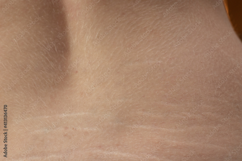 Fototapeta premium Woman showing stretch marks on her back. Scars from stretch marks on the back of the lower back