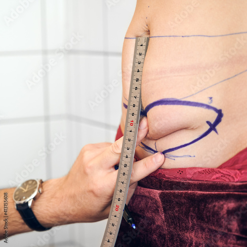Close up of plastic surgeon hand measuring woman abdomen with ruler before cosmetic surgery. Male doctor checking belly fat of female patient. Concept of abdominoplasty and preparation for surgery.