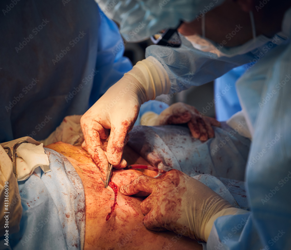 Close up of male doctor in sterile gloves placing sutures after abdominoplasty surgery. Plastic surgeon performing abdominal plastic surgery in operating room. Concept of medicine and cosmetic surgery