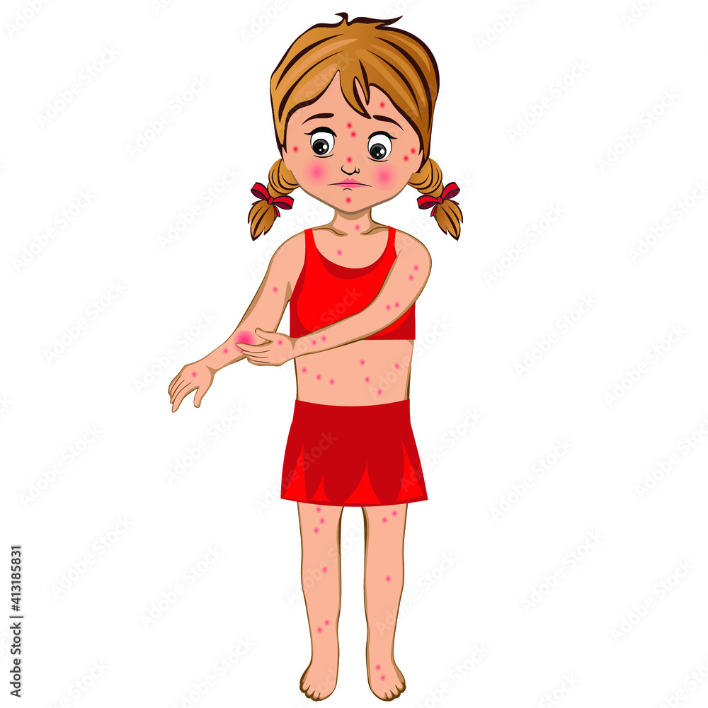 The girl's skin itches. Girl with Itches itchy blisters symptom ill with measles chicken pox pimples. Vector illustration The girl's skin itches. Girl with Itches itchy blisters symptom ill with measles chicken pox pimples. Vector illustration