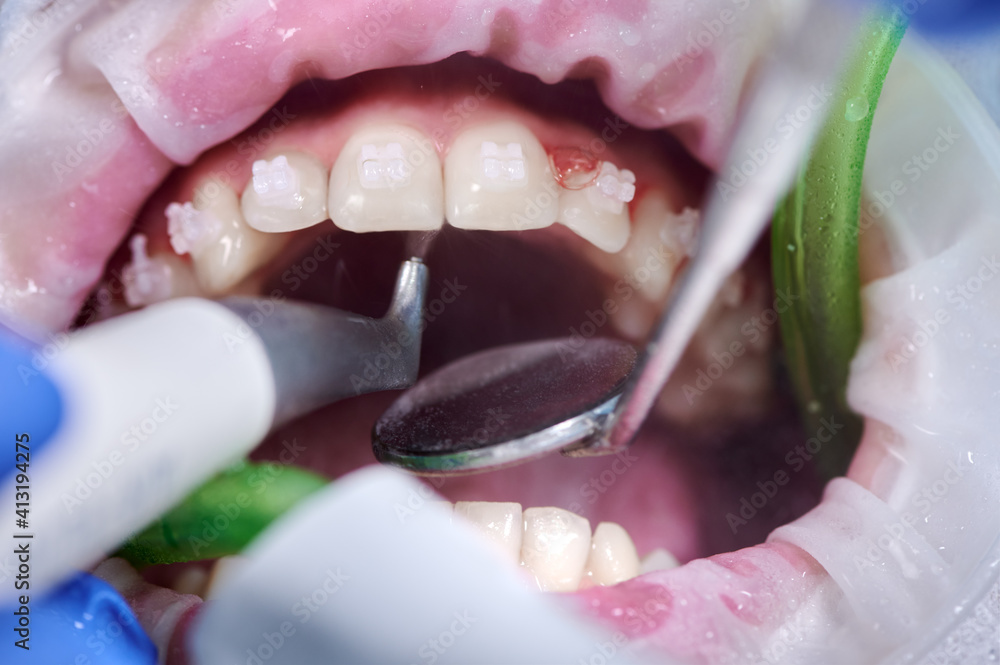 Close up photography. Top view on cleaning process in patient's mouth