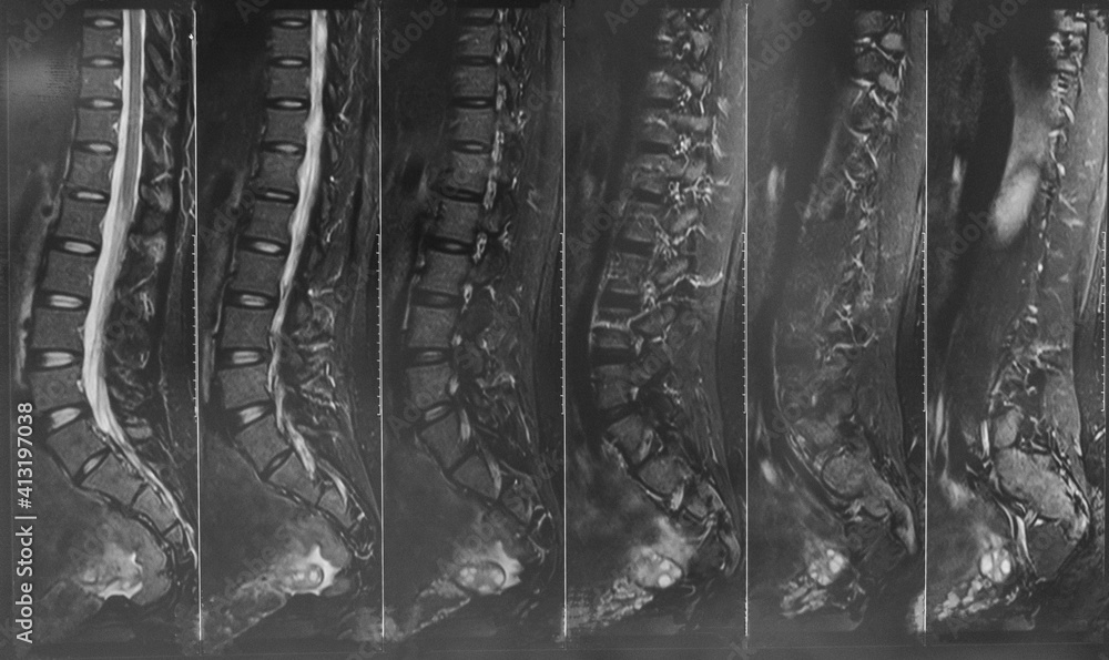 X ray MRI of lumbosacral spine (LS spine) case of low back pain