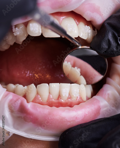 Dentist checking patient's lower teeth with a help of mirror. Close up view to beautiful white teeth with ceramic brackets during dental procedure. Cheek retractor on lips. Concept of dentistry