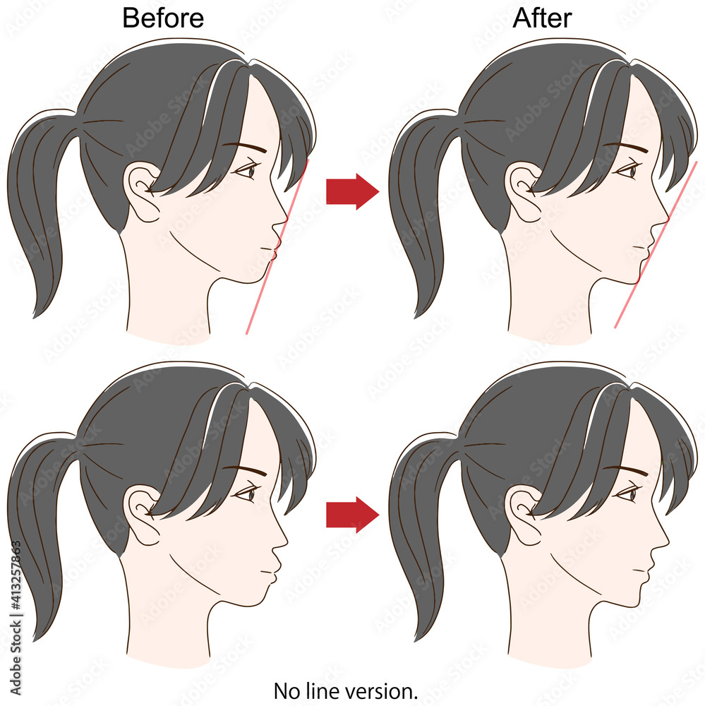 歯列矯正をした成人女性の横顔ビフォーアフターイメージ Stock Vector Adobe Stock