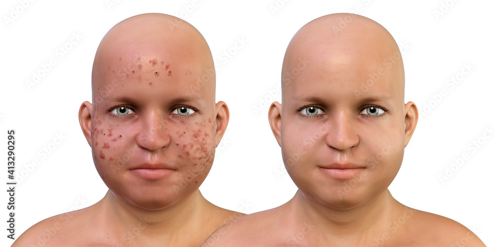 Acne vulgaris in a teenager overweight boy Acne vulgaris in a teenager overweight boy