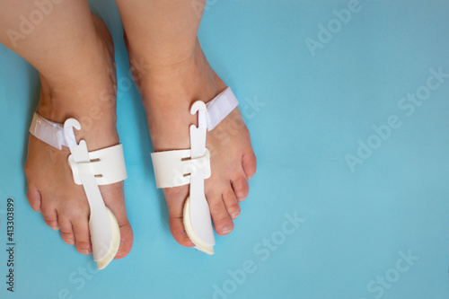 Female bare feet in Bunion Correctors for relief and treat pain in Hallux Valgus on blue background, big toe joint. Treatment of hammer toe