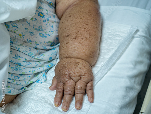 Lymphatic edema in a elderly female due to axillary emptying for breast cancer photo