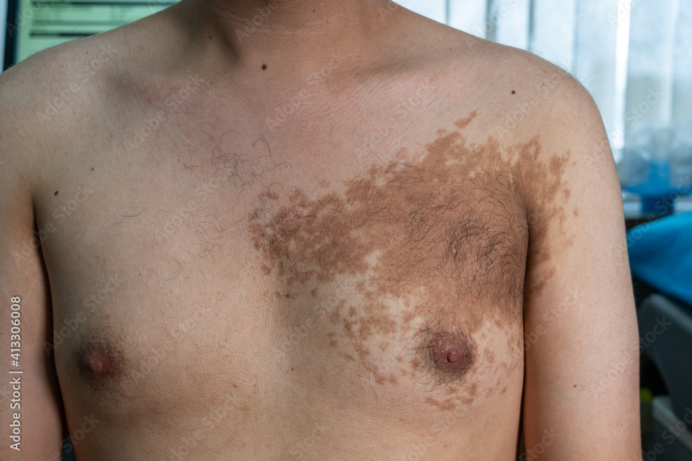 Naklejka premium Young male with Becker’s nevus on the left upper chest 