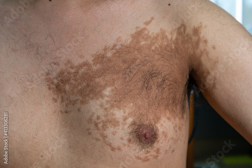 Young male with Becker’s nevus on the left upper chest  photo