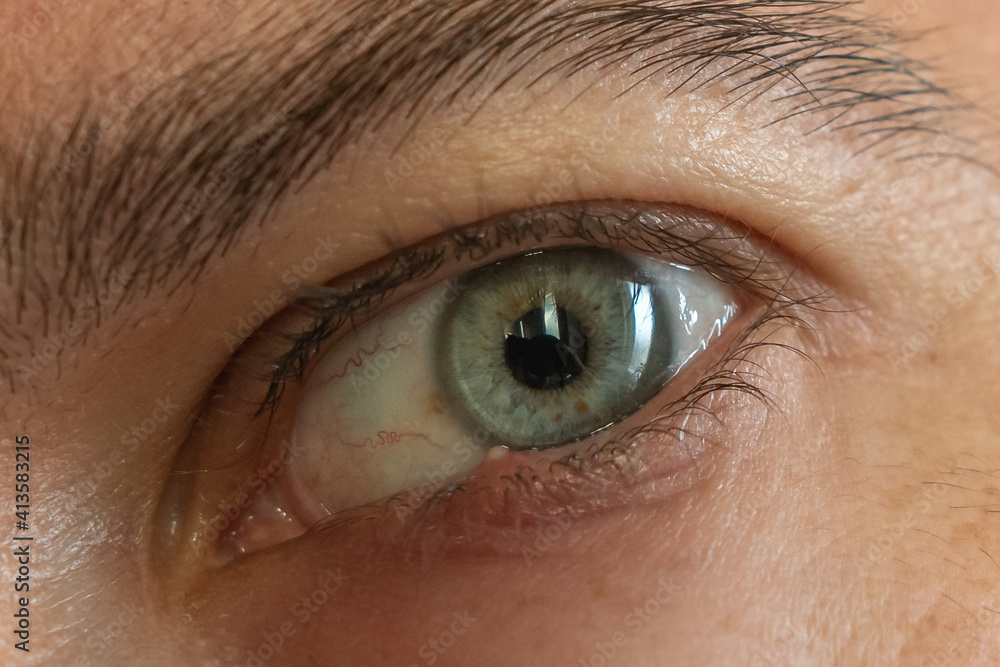 Das Auge ist Entzündet Gerstenkorn Bakterien im Auge 素材庫相片 Adobe Stock