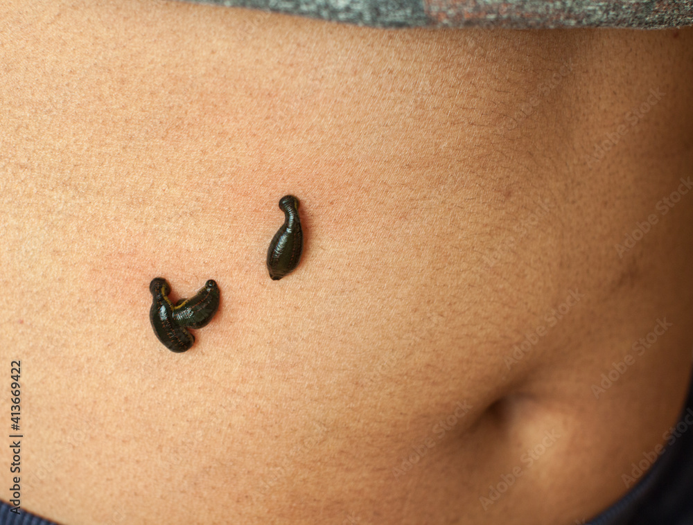 Fototapeta premium Ayurvedic medical leech liver treatment
