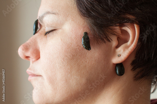 Ayurvedic medical leech eyesight treatment