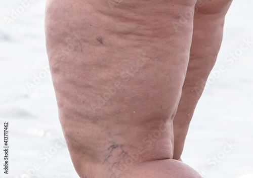 Fat and veins in a woman's legs. photo