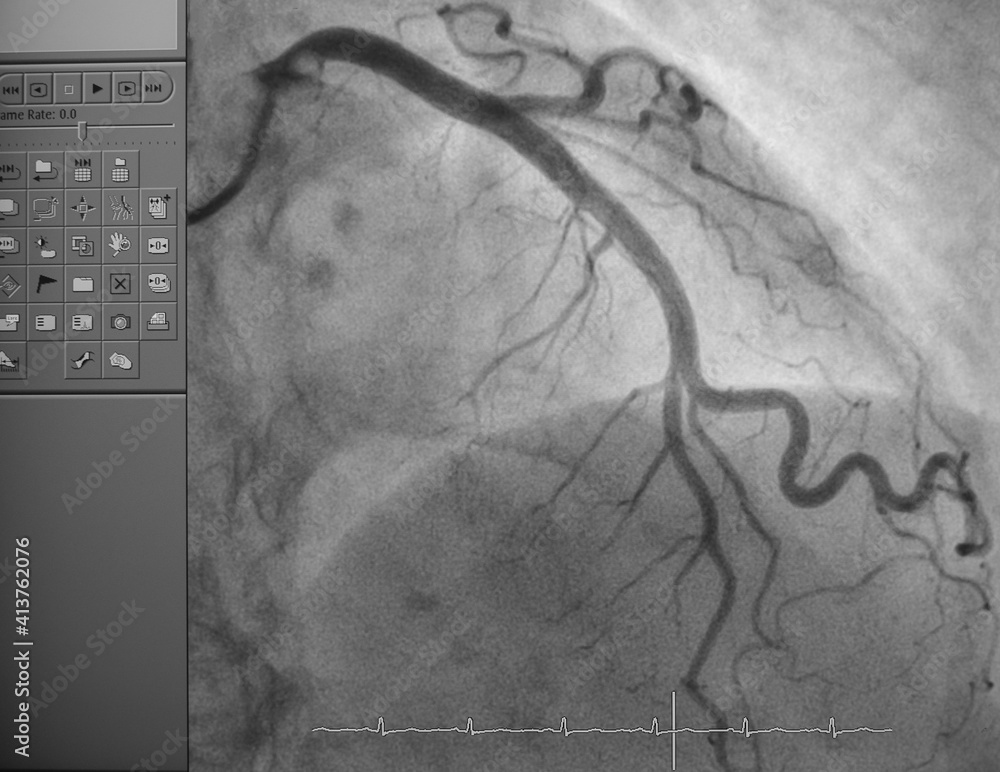 Coronary angiogram , medical xray for heart disease. Coronary artery disease. Stock Photo