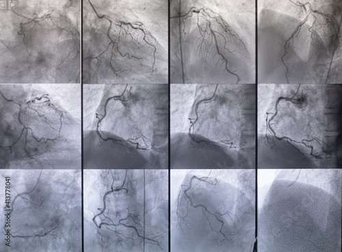 Canvastavla Coronary angiogram , medical x-ray for heart disease
