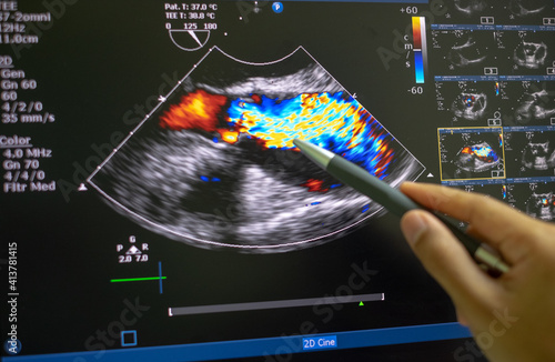 Echocardiography (ultrasound) machine. doppler of aortic stenosis photo